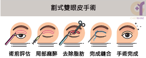 割雙眼皮手術流程圖