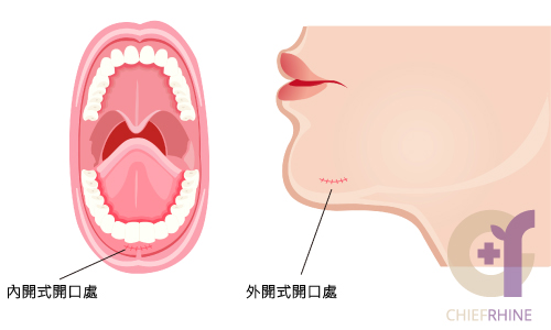 墊下巴手術開口位置示意圖