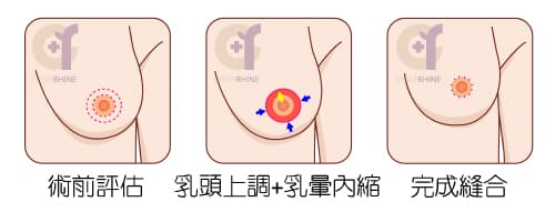 乳暈周圍提乳法，適合改善「輕度」胸部外擴下垂