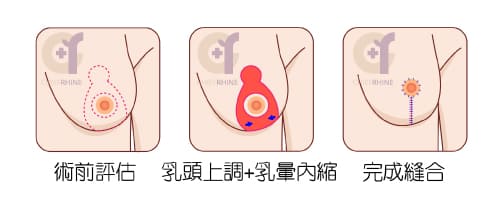 垂直切口提乳法，適合改善「輕／中度」胸部外擴下垂