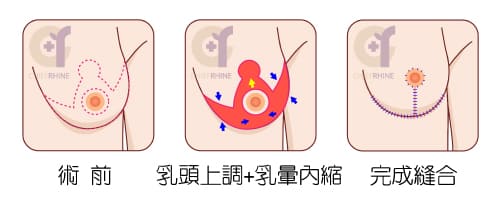 倒T切口提乳法，適合改善「嚴重」胸部外擴下垂