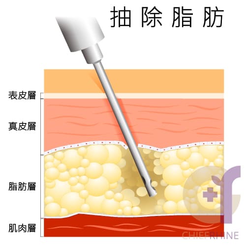 抽脂手術脂肪示意圖