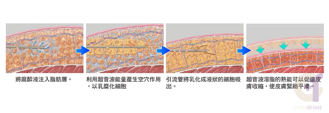 超音波溶脂流程圖