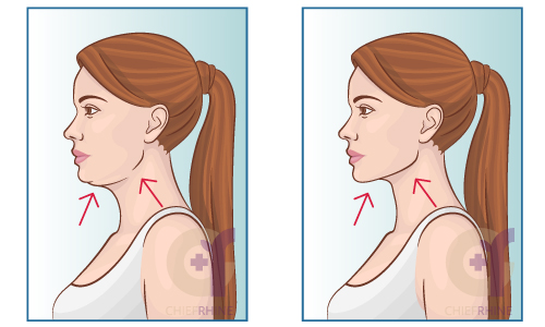 fat-removal on face