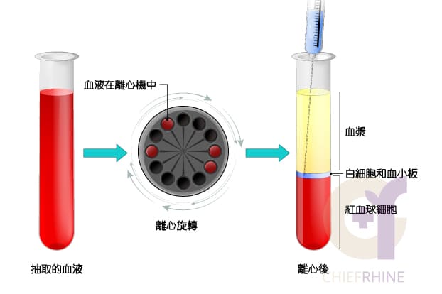 自體脂肪移植，離心示意圖