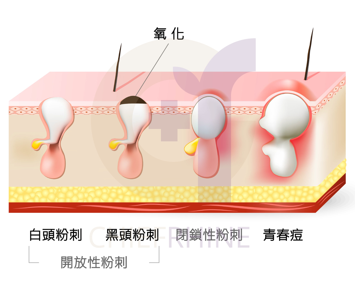 粉刺、皮脂管絲、痘痘